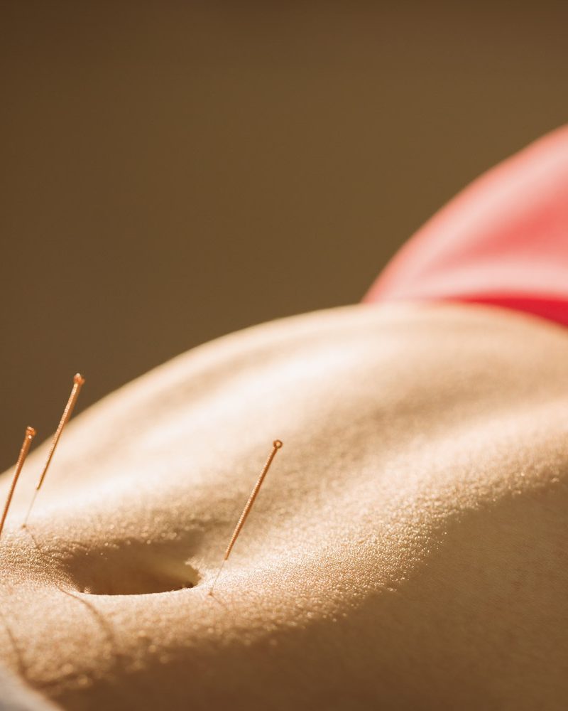 young-woman-getting-acupuncture-treatment-in-thera-2021-08-28-16-10-51-utc